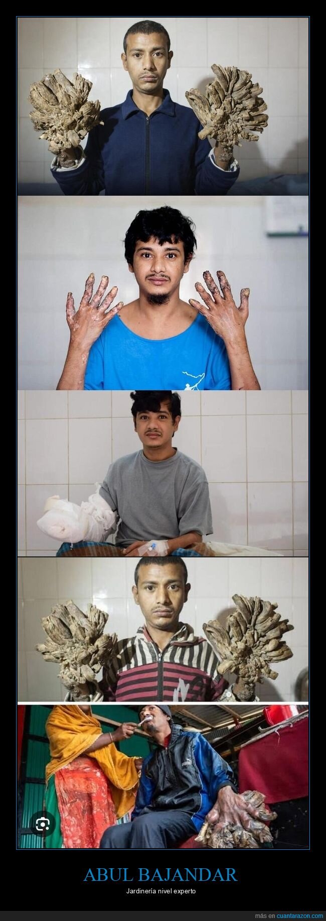 Banglad&eacute;s,verrugas,cirug&iacute;a,superaci&oacute;n,rareza