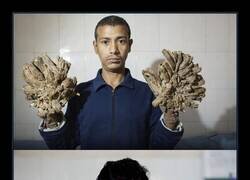 Enlace a Abul Bajandar fue un hombre de Bangladesh conocido mundialmente por una rara enfermedad que le causaba crecimientos en la piel similares a corteza de árbol en manos y pies