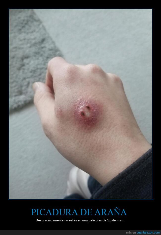 ara&ntilde;a,picadura,mano,hinchaz&oacute;n,herida