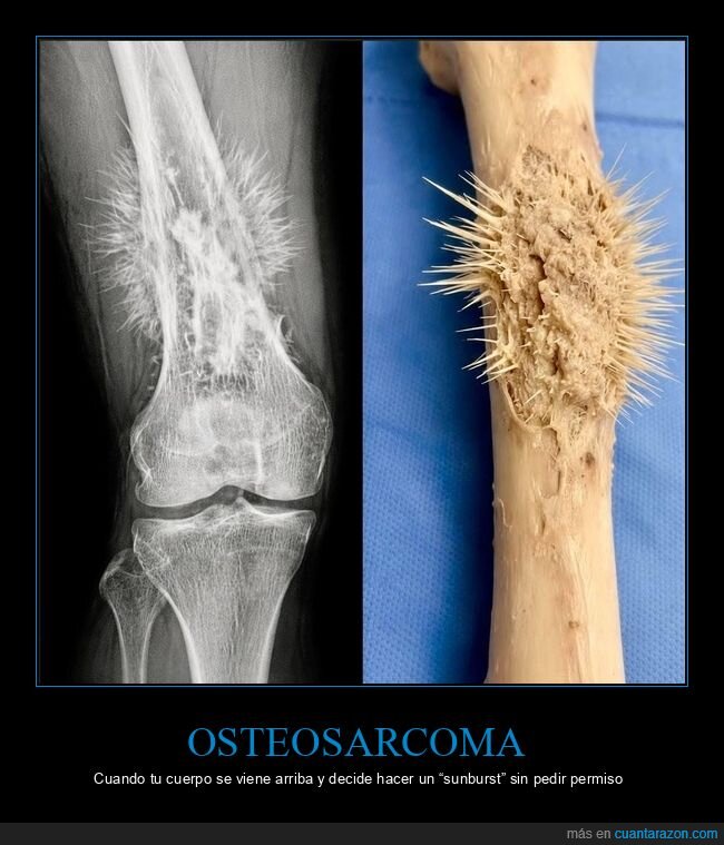 osteosarcoma,radiograf&iacute;a,hueso,oncolog&iacute;a,sunburst
