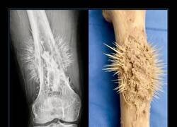 Enlace a Esta es la apariencia en forma de ráfaga solar del osteosarcoma, el cáncer óseo primario más común