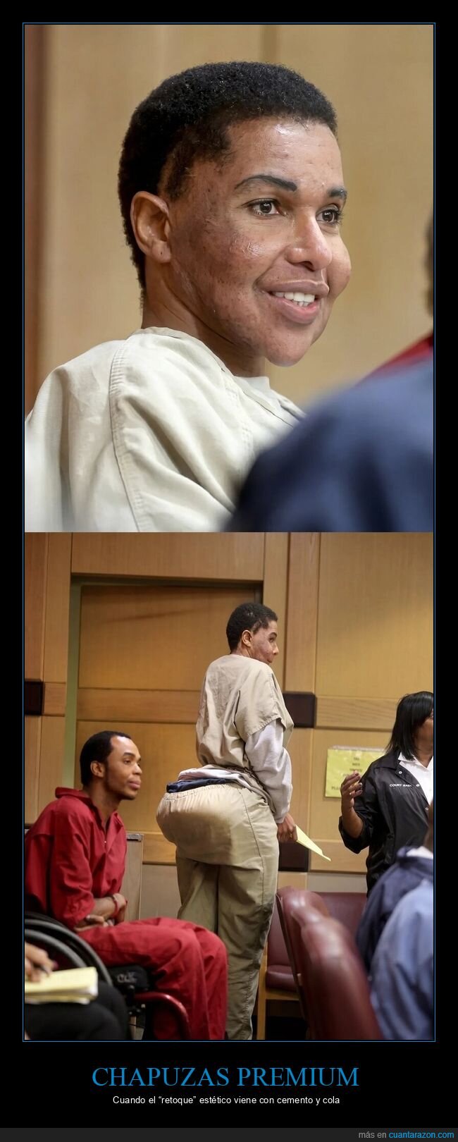 cirugia,cemento,pegamento,estafa,juicio