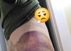 Enlace a Moratones resultantes de un accidente de moto a baja velocidad