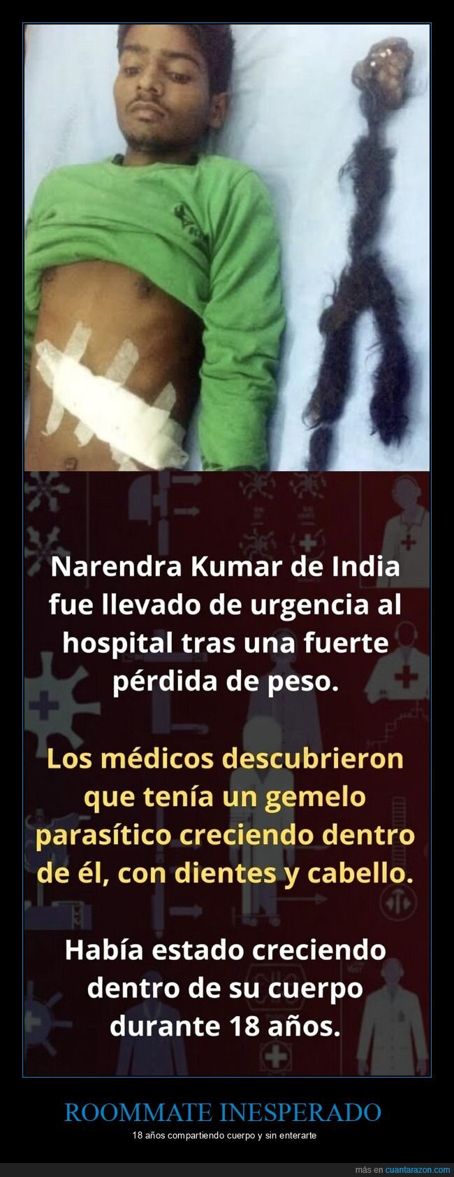 par&aacute;sito,gemelo,India,hospital,cirug&iacute;a