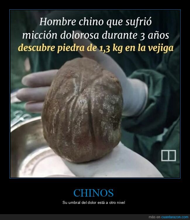 c&aacute;lculo,vejiga,dolor,m&eacute;dico,desgracia