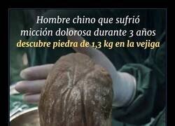 Enlace a Se encontró una piedra de 1,3 kg en la vejiga de un hombre chino