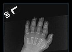 Enlace a Radiografía de la mano de un bebé antes de que los huesos se fusionen