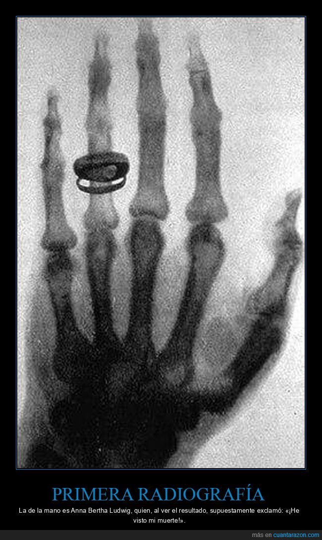 R&ouml;ntgen,radiograf&iacute;a,anillo,matrimonio,ciencia