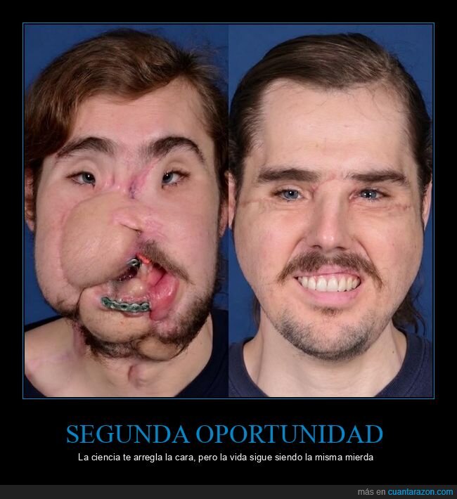 trasplante,rostro,cirug&iacute;a,cambio,medicina
