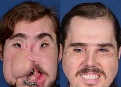 Enlace a Cameron Underwood, antes y después de recibir un trasplante facial en 2018