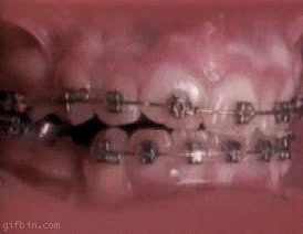 brackets,aparato,dientes,ortodoncia