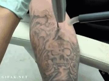 tatuaje,quitar,genial,tecnología
