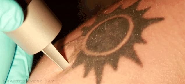 eliminar,laser,quitar,tatuaje,borrar