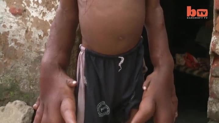 mano,gigante,ni&ntilde;o,indio,india,mutaci&oacute;n,condici&oacute;n,grande,desproporcionado