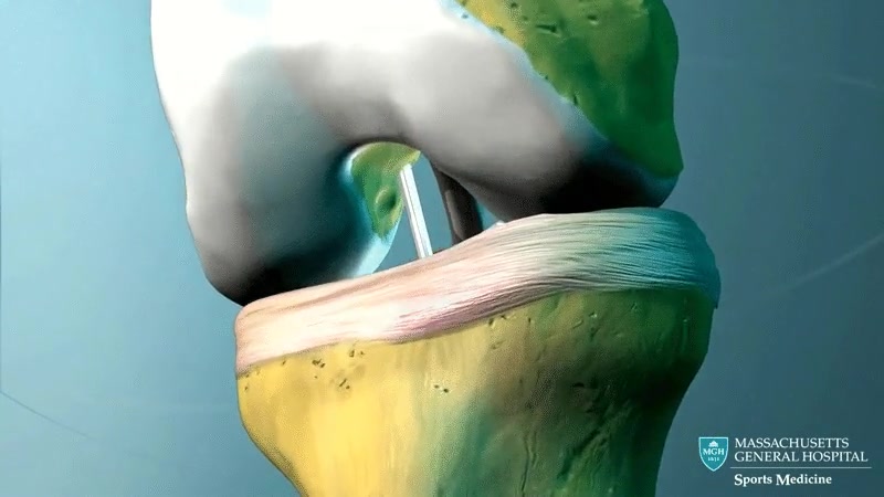 massachusetts,ligamento,cruzado,anterior,operacion,rodilla,tendones
