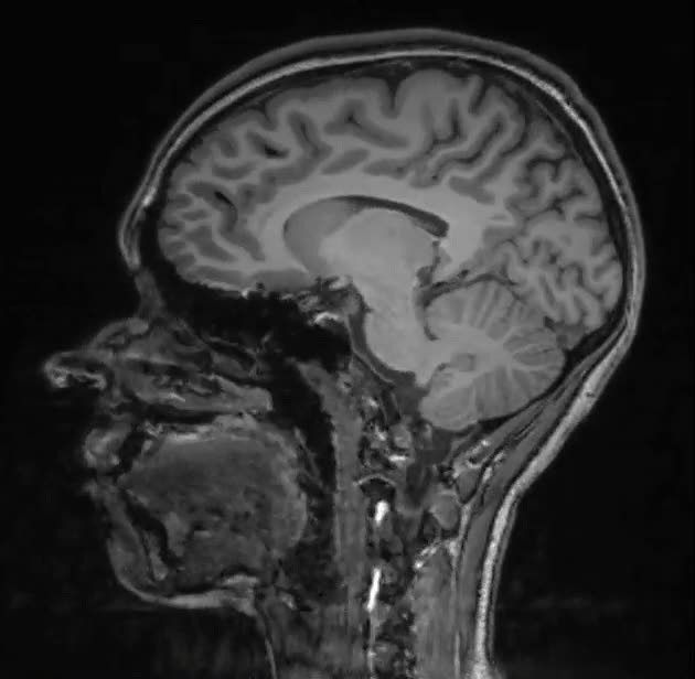 resonancia magnetica,MRI,cerebro,craneo,animacion