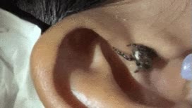 ara&ntilde;a,trauma,oreja,aracnido,impresion,liquido,parasito,colarse,oido