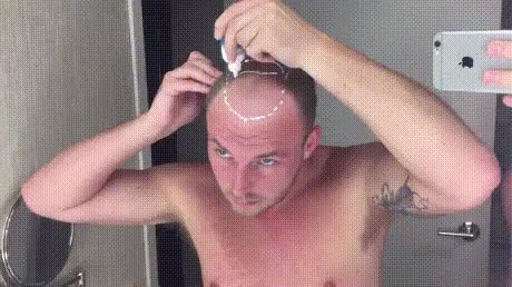 calvo,problema,peluca,flequillo,peinar