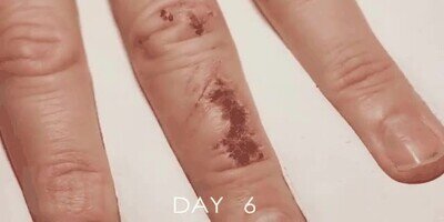 Enlace a Timelapse de cómo cicatriza una herida en un dedo