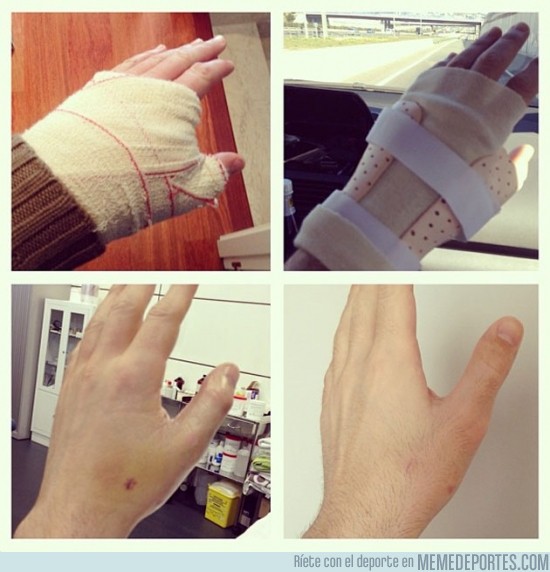 94679 - La evolución de la mano de Iker Casillas