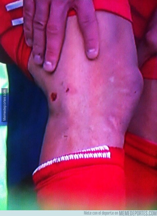 214123 - Así quedó la pierna de Luis Suárez por el entradón de Mirallas (Everton)