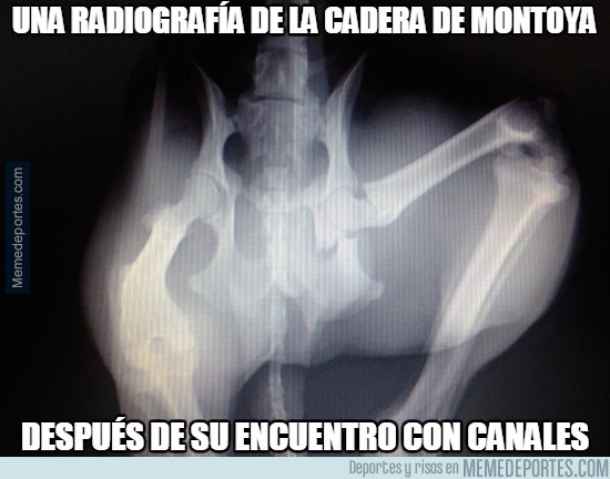 429747 - Una radiografía de la cadera de Montoya