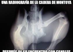 Enlace a Una radiografía de la cadera de Montoya