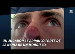 Enlace a Le arrancan un trozo de nariz en un partido de fútbol
