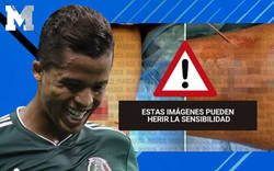 Enlace a Así es como le cosieron el muslo a Gio Dos Santos para déjarselo como nuevo tras el destrozo que le hizo Briseño