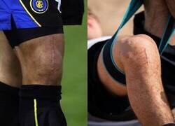 Enlace a Evolución de la cicatriz que deja una reconstrucción de ligamentos.