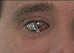 Enlace a Documentalista tuerto se implanta una cámara en el ojo