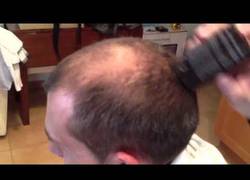 Enlace a Problem, alopecia?