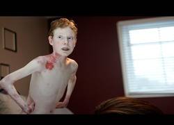 Enlace a Este pequeño sufre una enfermedad que le causa la pérdida de su piel [Abstenerse sensibles-Inglés]