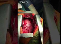 Enlace a [ABSTENERSE SENSIBLES] La increíble extracción de un cuchillo a corazón abierto