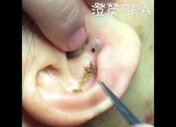 Enlace a Los efectos secundarios tras no lavarte bien el agujero que deja un piercing