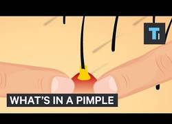 Enlace a [Subtítulos] Te lo han dicho mil veces: no te petes los granitos, NO LO HAGAS