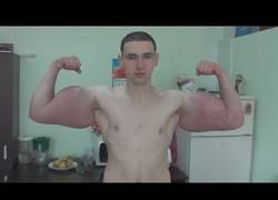 Enlace a Este ruso podría terminar sin brazos si sigue inyectándose Synthol casero