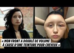 Enlace a A esta mujer se le deforma la cara por aplicarse un tinte en el pelo [Francés]