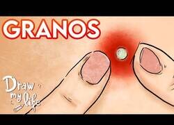 Enlace a El 'Draw My Life de por qué nos salen granos