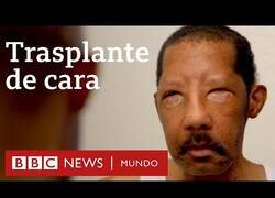 Enlace a Así es la vida tras un transplante de cara