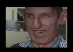 Enlace a Así es la vida de un hombre con gigantismo