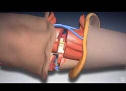 Enlace a Así se lleva a cabo un transplante de mano