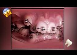 Enlace a Así evoluciona una dentadura con brackets en 2 años
