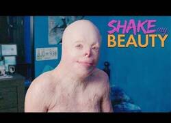 Enlace a Así es vivir con un 95% de quemaduras en tu cuerpo