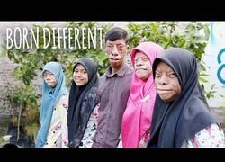 Enlace a Esta familia padece una enfermedad que les hace lucir un rostro diferente