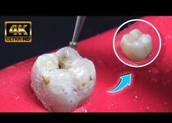 Enlace a Así quitan la caries y restauran la muela los dentistas