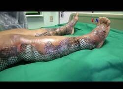 Enlace a La piel de pez que sirve para curar quemaduras