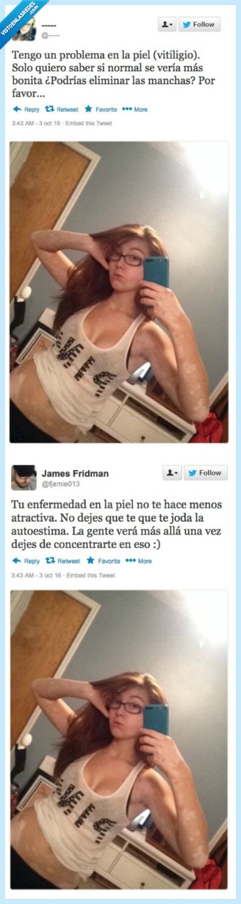 vitiligio,enfermedad,mancha,autoestima