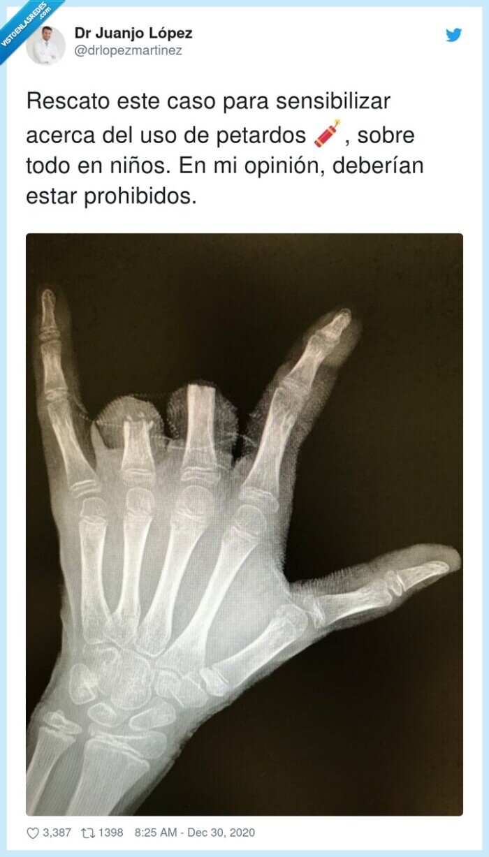 sensibilizar,prohibido,opinión,petardos,dedos,radiografia