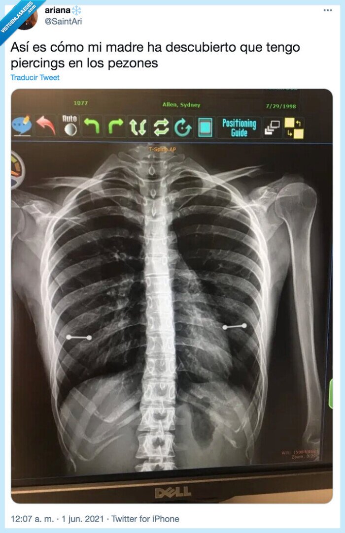 radiografía,pezones,piercing